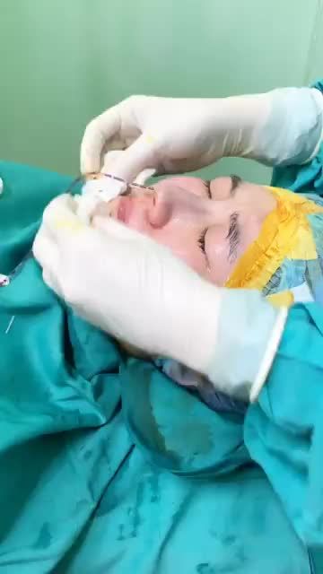 THÀNH QUẢ SAU NÂNG MŨI 3D S-LINE KẾT HỢP BỌC MÔ SÓNG MŨI