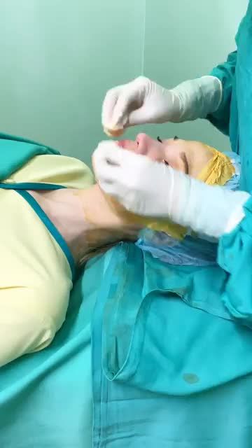 THÀNH QUẢ SAU NÂNG MŨI BỌC SỤN
