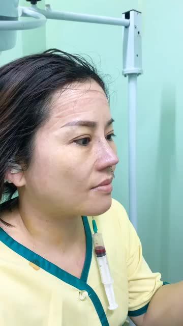 THÀNH QUẢ SAU NÂNG MŨI CẤU TRÚC - ĐẸP MỸ MÃN