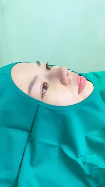 THÀNH QUẢ SAU NÂNG MŨI CẤU TRÚC KẾT HỢP MÀI XƯƠNG GỒ