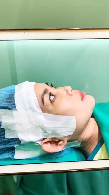 THÀNH QUẢ SAU NÂNG MŨI CẤU TRÚC NANO KẾT HỢP BỌC MÔ SÓNG MŨI