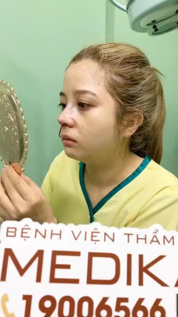 THÀNH QUẢ SAU NÂNG MŨI CẤU TRÚC NANO KẾT HỢP MÀI XƯƠNG GỒ