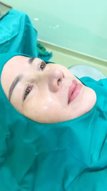 THÀNH QUẢ SAU NÂNG MŨI DIKA PLUS
