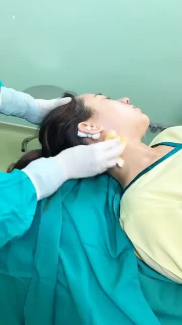 THÀNH QUẢ SAU NÂNG MŨI SIÊU CẤU TRÚC NANO KẾT HỢP THU CÁNH MŨI