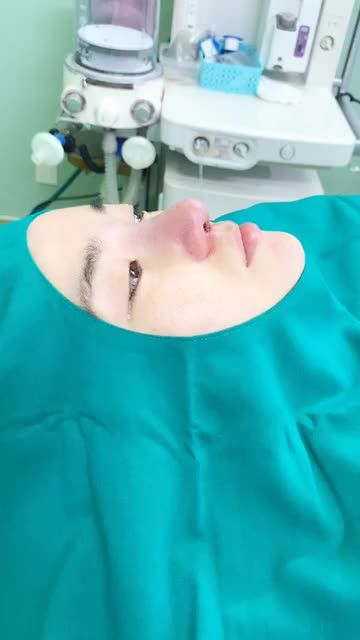 THÀNH QUẢ SAU NÂNG MŨI SỤN SƯỜN MEDIKA