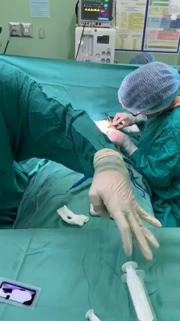 THÀNH QUẢ SAU NÂNG VÒNG 1 TÚI NANO CHIP PERFECT KẾT HỢP TẠO KHE N.G.Ự.C VÀ THU QUẦNG