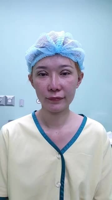 THÀNH QUẢ SAU TẠO HÌNH MẮT ĐẸP