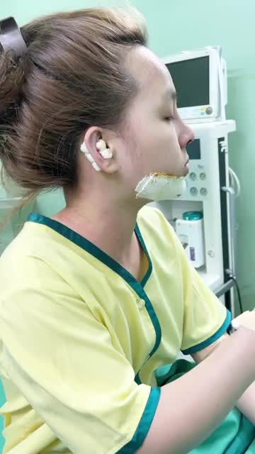 THÀNH QUẢ SAU THỰC HIỆN COMBO NÂNG MŨI SIÊU CẤU TRÚC NANO và ĐỘN CẰM V-LINE MỸ