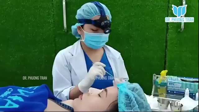 THÁO NẸP SAU 7 NGÀY NÂNG MŨI SỤN SƯỜN TỰ THÂN