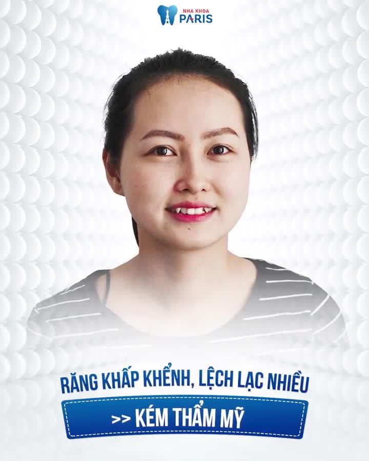 Tháo niềng răng XÔ LỆCH Kết quả mỹ mãn