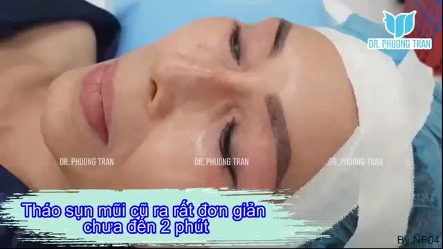 THÁO SỤN MŨI CŨ CÓ KHÓ KHÔNG? CÓ TỐN NHIỀU THỜI GIAN KHÔNG?