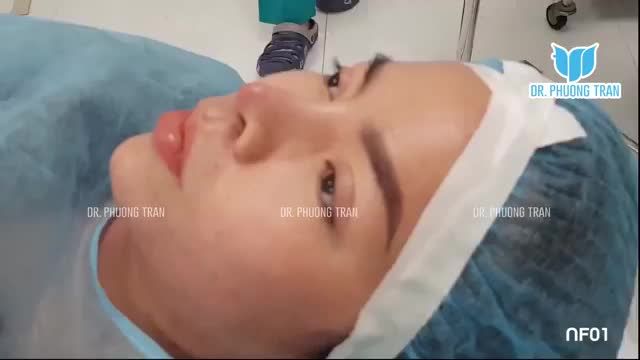 THÁO SỤN MŨI CŨ, KHẮC PHỤC MŨI BỊ VIÊM BẰNG CÁCH ĐẶT TRUNG BÌ MỠ