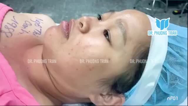 THAY ĐỔI NGOẠN MỤC NGAY SAU NÂNG MŨI SỤN SƯỜN TOÀN PHẦN