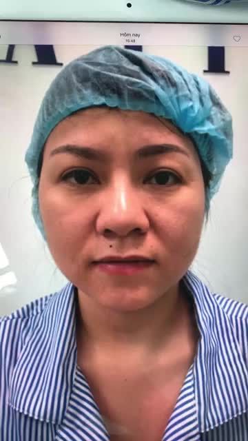 Tiếp tục một ca mũi sửa lại (đã nâng sụn nhân tạo cách đây 15 năm), sống mũi võng, đầu mũi to hếch, cánh mũi không đều