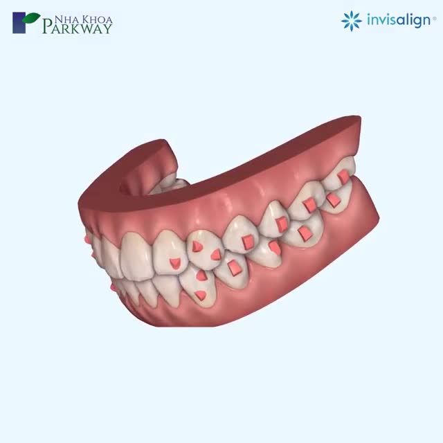 TÌM LẠI TỰ TIN TRONG GIAO TIẾP VỚI NIỀNG RĂNG INVISALIGN