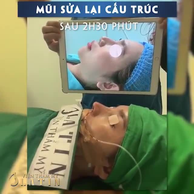 Trả kết quả ca mũi cấu trúc sửa lại cho chị khách hàng đã nâng mũi hơn 10 năm trước đây ạ.