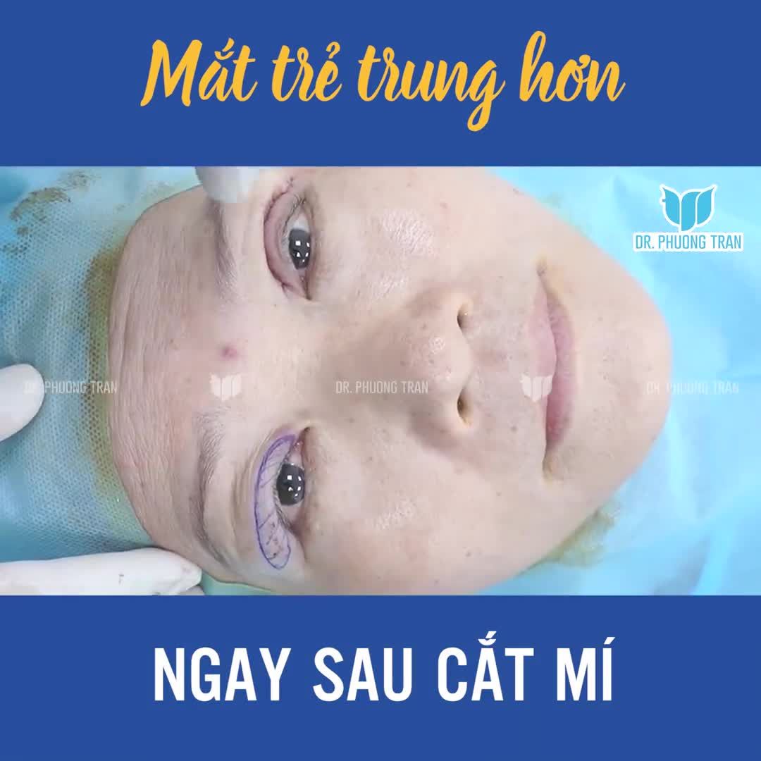 TRẺ HƠN MẤY TUỔI CHỈ SAU 30 PHÚT CẮT MÍ, LOẠI BỎ DA DƯ VÀ MỠ THỪA