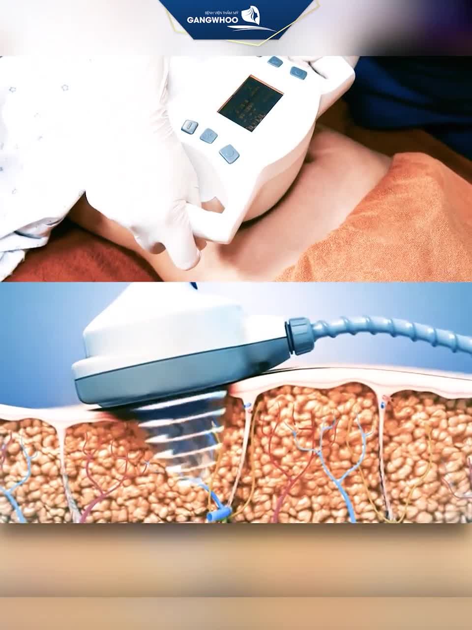 TRIỆT TIÊU MỠ THỪA LẤY LẠI EO THON CHỈ 60 PHÚT!!!