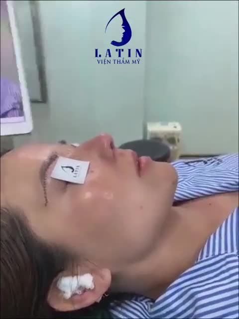 Trọn gói combo Mũi cấu trúc sửa lại + Nâng cung mày nhà Latin ngay sau khi làm xong đây ạ