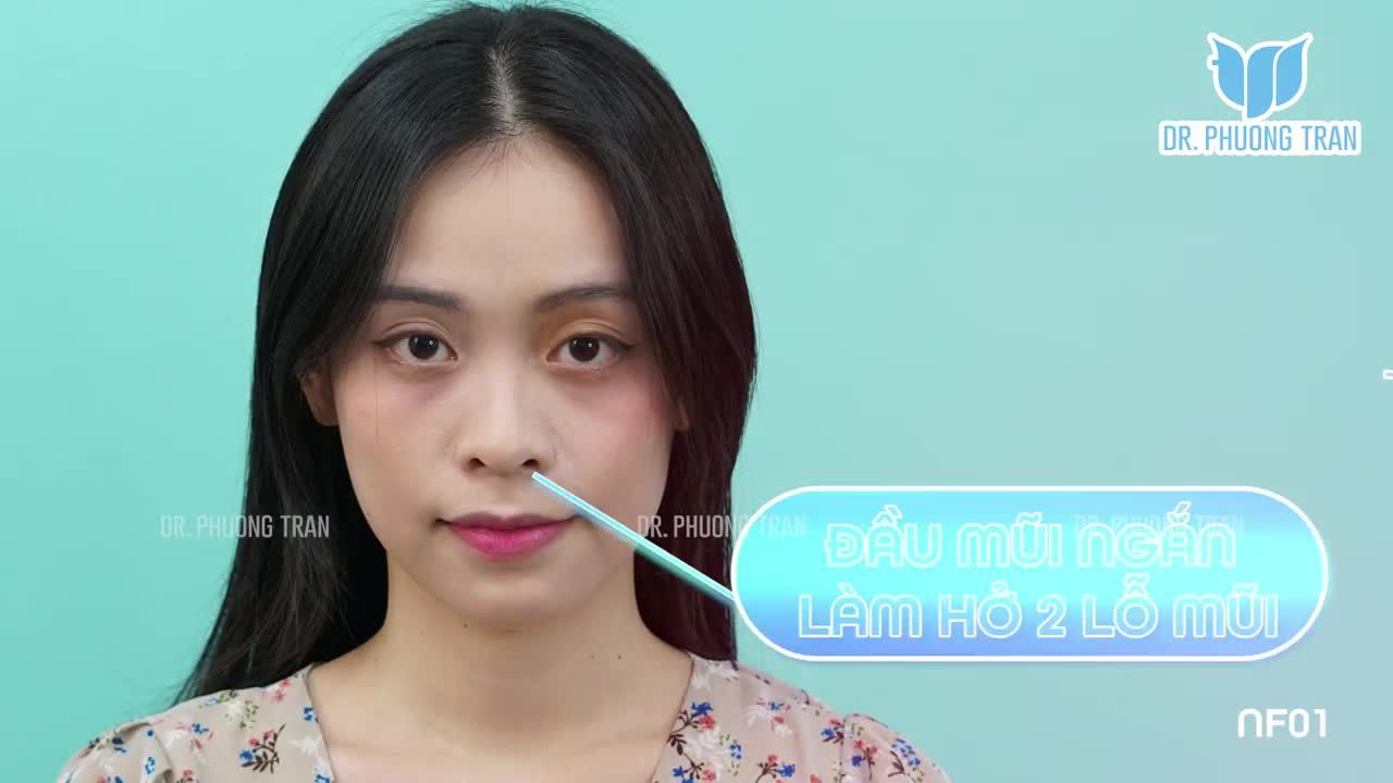 TRỌN VẸN 14 NGÀY THAY ĐỔI SAU NÂNG MŨI SỤN SƯỜN
