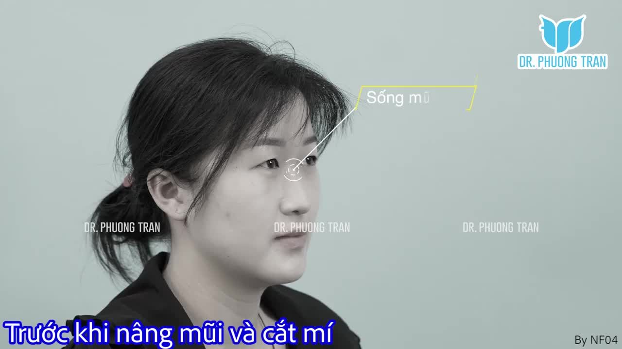 TRỌN VẸN HÀNH TRÌNH 14 NGÀY HỒI PHỤC NÂNG MŨI SỤN SƯỜN + CẮT MÍ