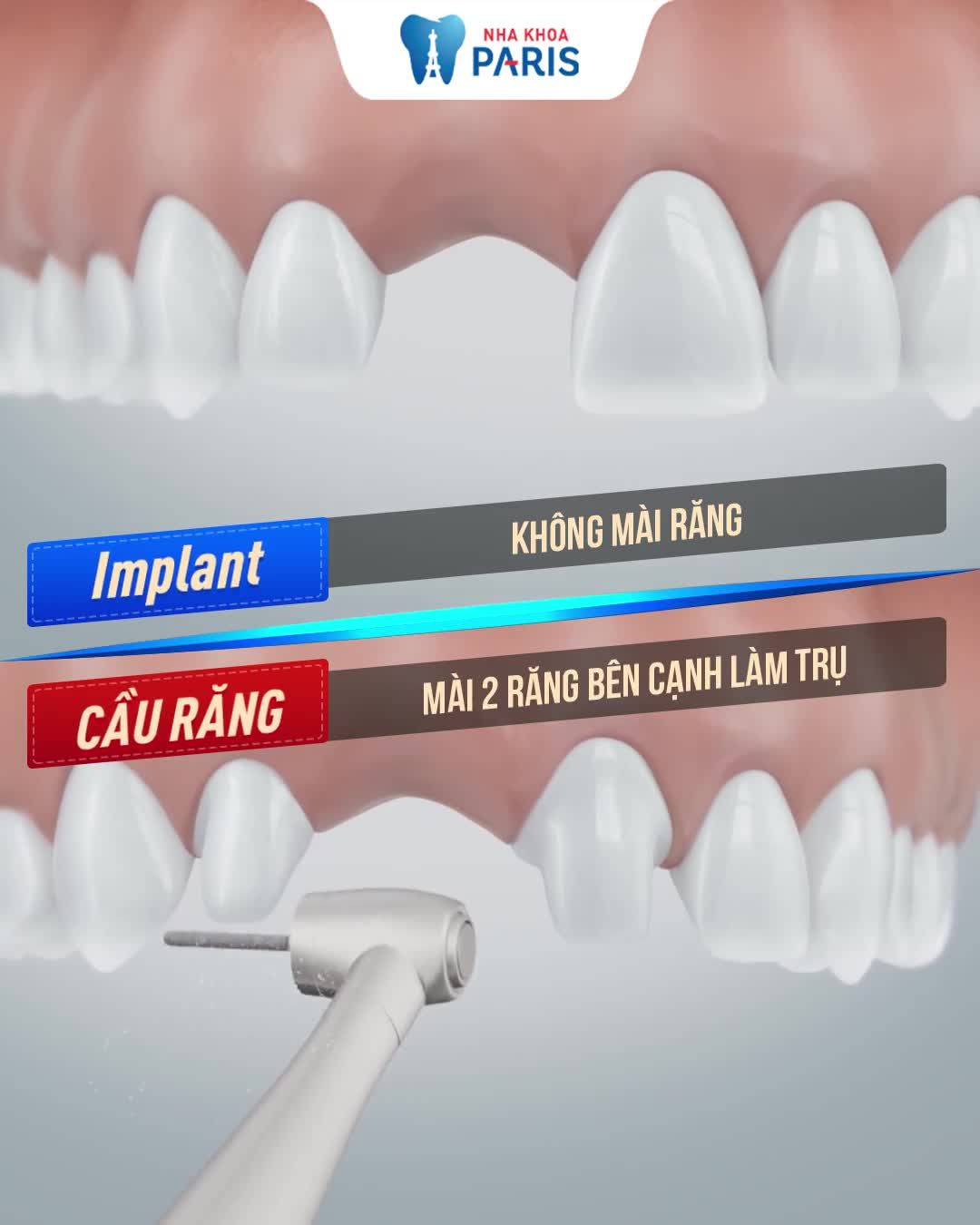 TRỒNG RĂNG: Chọn cầu răng hay Implant?