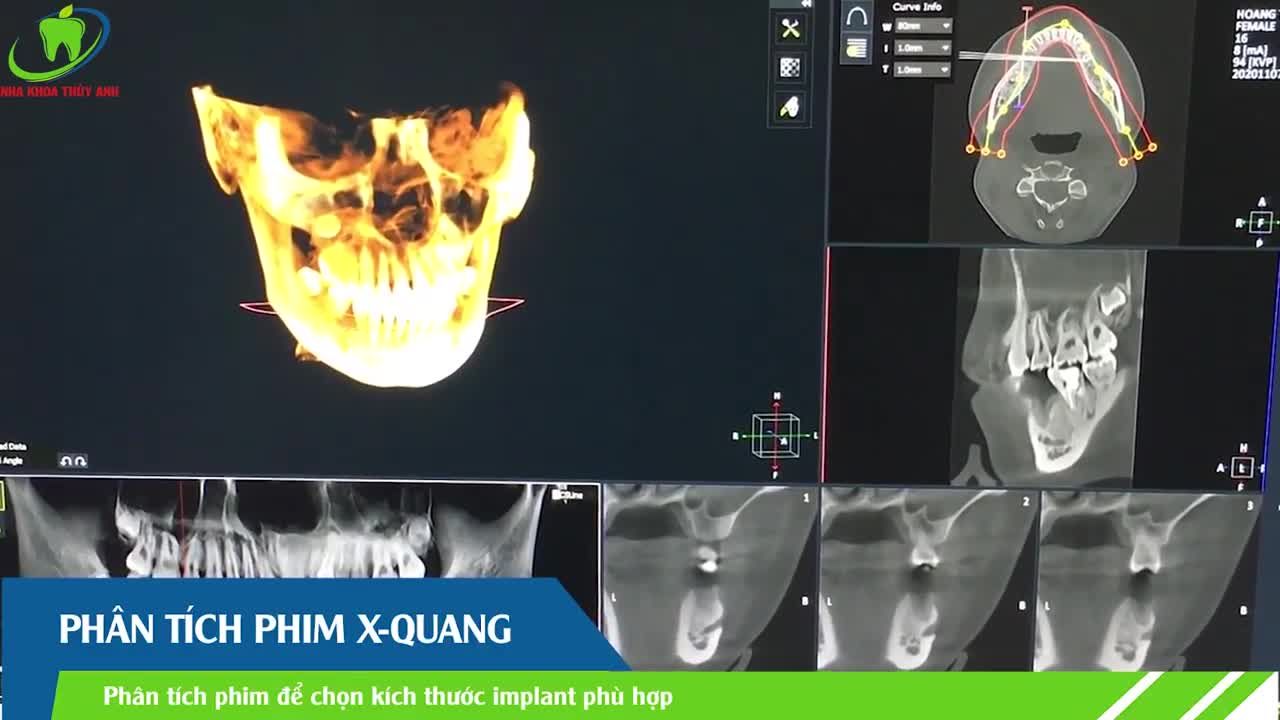 TRỒNG RĂNG IMPLANT CÓ ĐAU KHÔNG?