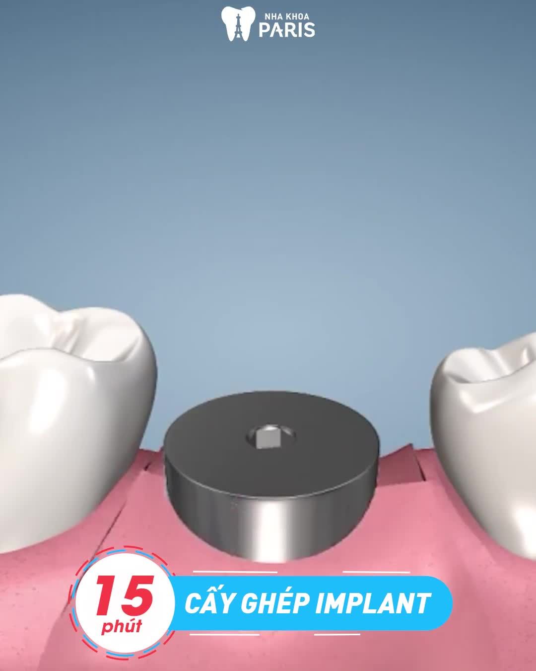 Trồng răng mới sau 5 ngày Ăn ngon trọn đời