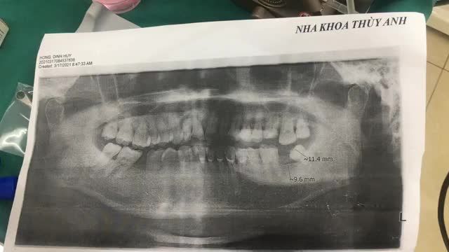 Trực tiếp ca cấy ghép chân răng nhân tạo implant cho khách hàng tại nha khoa Thuỳ Anh.