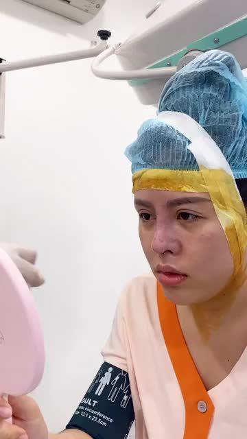 Vì sao nâng mũi cấu trúc nhưng vẫn ngắn hếch??