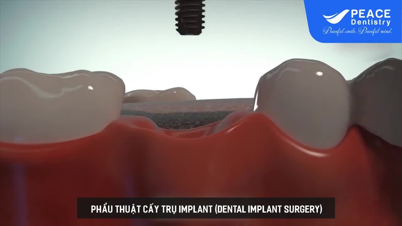VÌ SAO NHA SĨ KHUYÊN BẠN NÊN CẤY GHÉP IMPLANT KHÔI PHỤC RĂNG MẤT