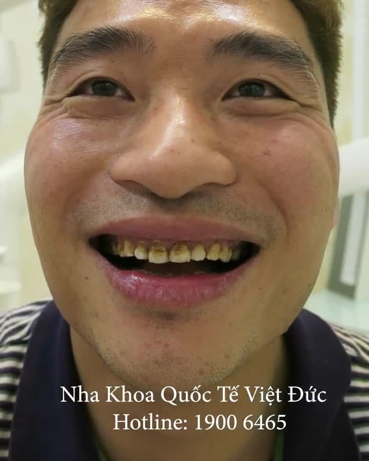 "VỢ LUÔN LUÔN ỦNG HỘ ANH" - NGUỒN ĐỘNG LỰC ĐONG ĐẦY YÊU THƯƠNG GIÚP ANH TỰ TIN THAY ĐỔI NỤ CƯỜI