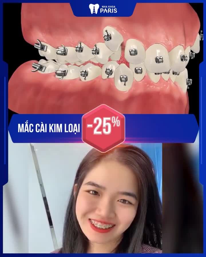 XU HƯỚNG NIỀNG RĂNG 4.0  HOT 2021