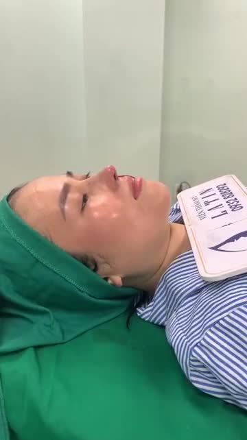 ZOOM CẬN CẢNH MŨI TÁI CẤU TRÚC SỬA LẠI LẦN 3