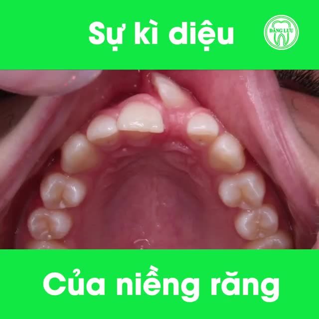10 CA NIỀNG RĂNG HOÀN TOÀN MỸ MÃN