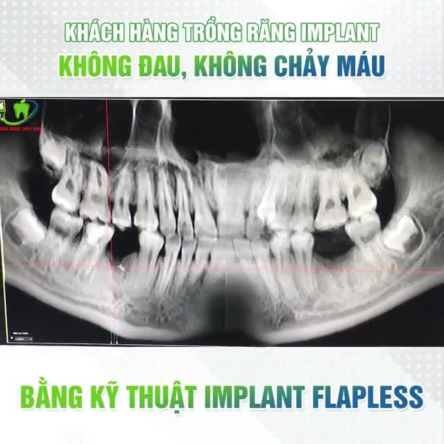 15.000 KHÁCH HÀNG ĐÃ THỰC HIỆN VÀ HÀI LÒNG KHI TRỒNG RĂNG IMPLANT VỚI KỸ THUẬT FLAPLESS