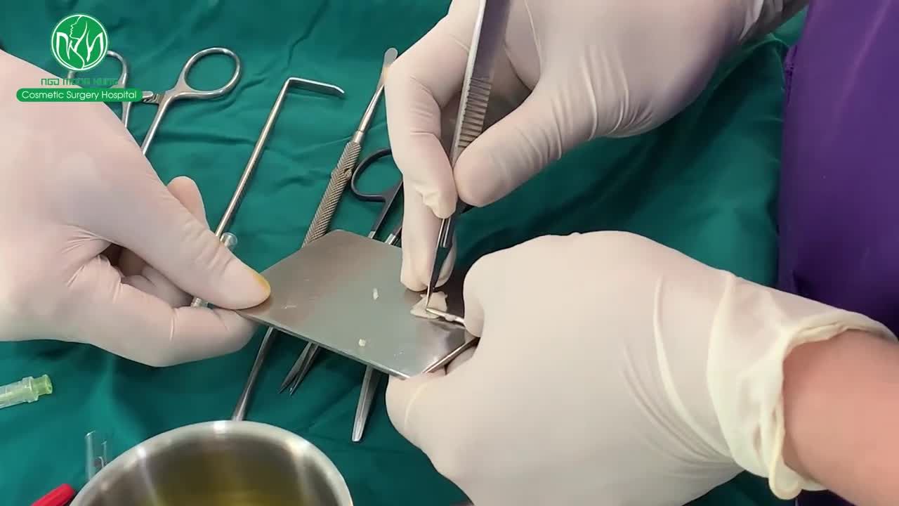 30 PHÚT THỰC HIỆN CHO MŨI THẤP "HÓA" CAO THON