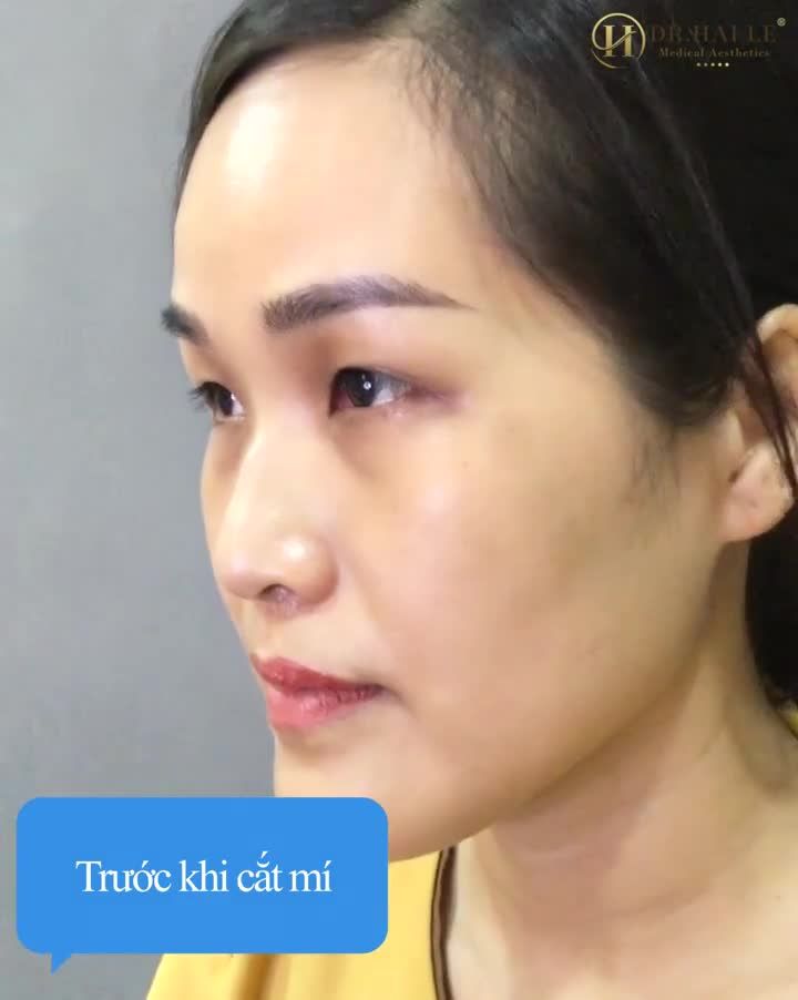 45 phút thẩm mỹ mắt, bừng sáng cả khuôn mặt