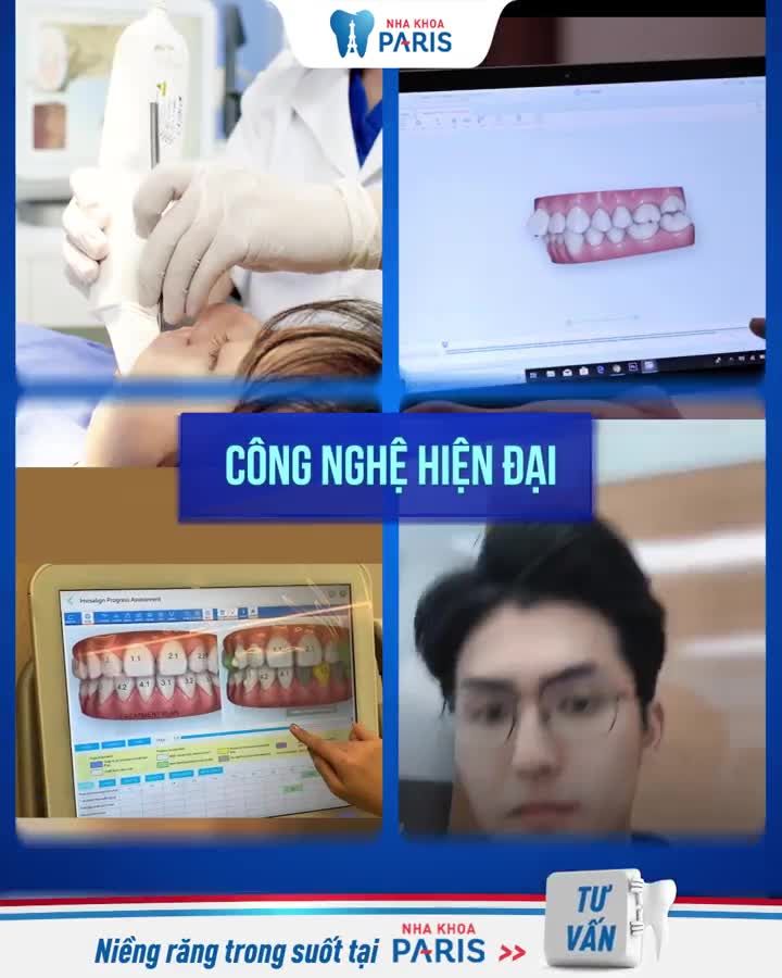 6 tháng - Răng hết xô lệch - tối ưu chi phí