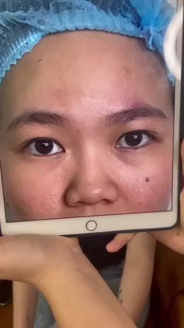 7 Ngày sau Cắt mí tại cơ sở HCM vị khách hàng hối hận vì đã không làm mí sớm hơn