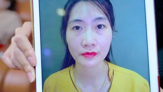 7 ngày sau combo cắt mí trên + cắt mí dưới >> đã hết sưng nề bầm tím chưa