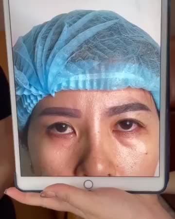 7 Ngày sau Phẫu thuật Nâng cung mày tại cơ sở HCM, trả lại đôi mắt 2 mí rõ nét, xóa bỏ hoàn toàn tình trạng da chùng sụp mí cho khách hàng