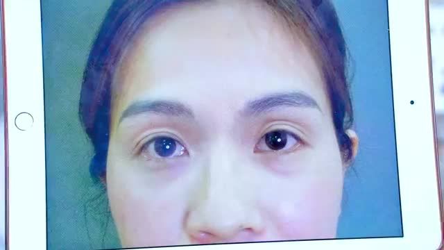 7 ngày sau tiểu phẫu Cắt mí khách hàng hạnh phúc chia sẻ "Trẻ ra trông thấy và biết thế này đi làm mí sớm hơn cho đẹp"  Mời bạn cùng đón xem để có động lực nhé