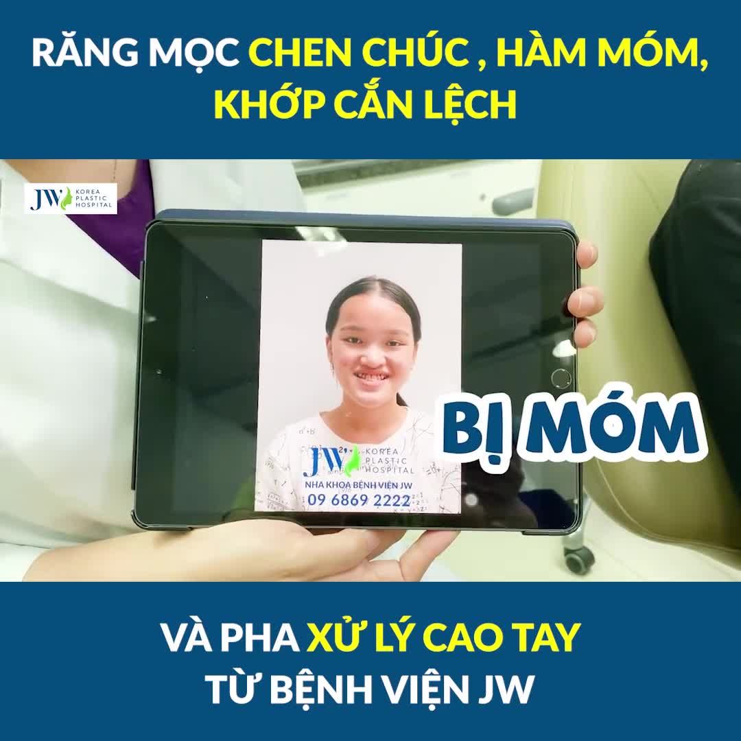 Ám ảnh kinh hoàng: RĂNG MỌC CHEN CHÚC, HÀM MÓM, KHỚP LỆCH