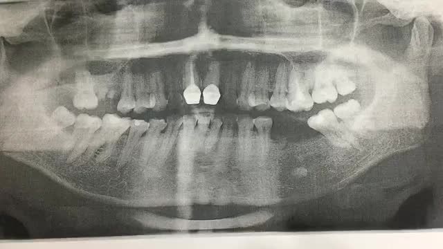Ca cấy 2 chân răng nhân tạo implant 35.36 cho khách hàng tại Nha Khoa Thuỳ Anh.