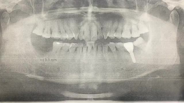 Ca cấy chân răng nhân tạo implant 47 cho khách hàng tại Nha Khoa Thuỳ Anh.