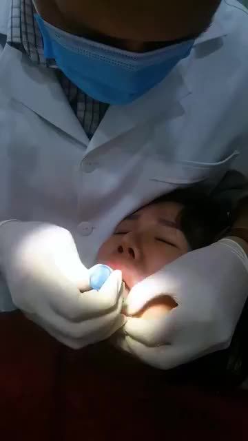 CA DÁN 16 VENEER SỨ CHO MỘT VỊ KHÁCH HÀNG
