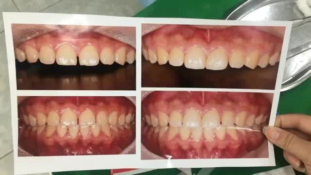 Ca gắn 2 mặt dán sứ veneer khắc phục tình trạng răng thưa cho khách hàng.