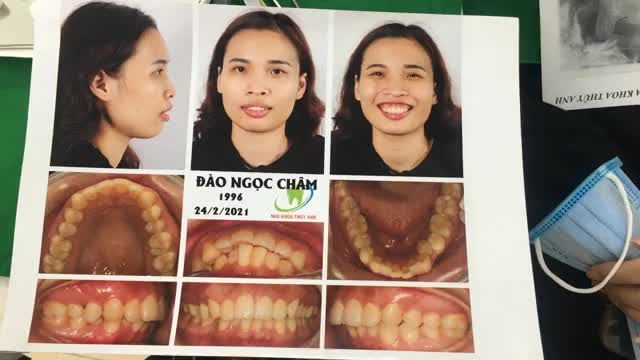 ca gắn mắc cài tại Nha Khoa Thuỳ Anh.