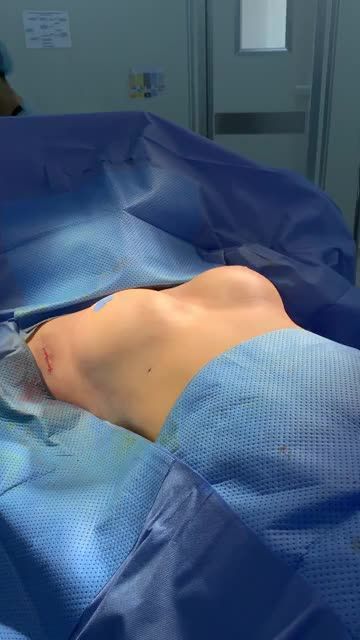 CA NÂNG NGỰC VỪA HOÀN THÀNH TẠI PHÒNG PHẪU THUẬT